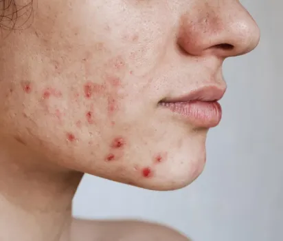 Akne: Nedir, Neden Olur ve Önleyici Yöntemler Nelerdir?